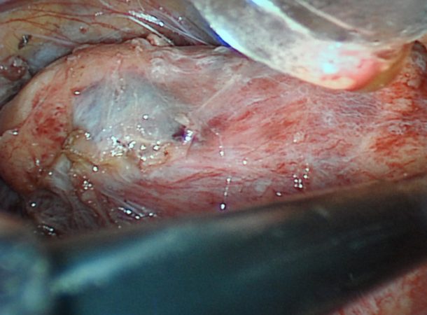 tumor-renal-por-videolaparoscopia-1024x768